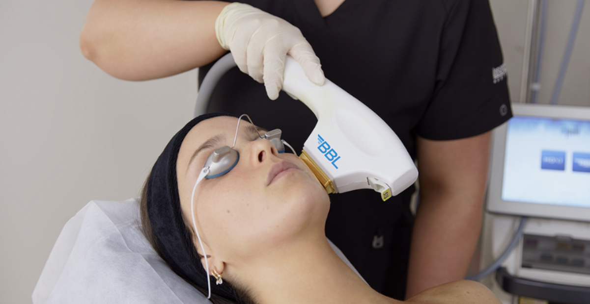 How BBL Treatments Help With Acne Scars