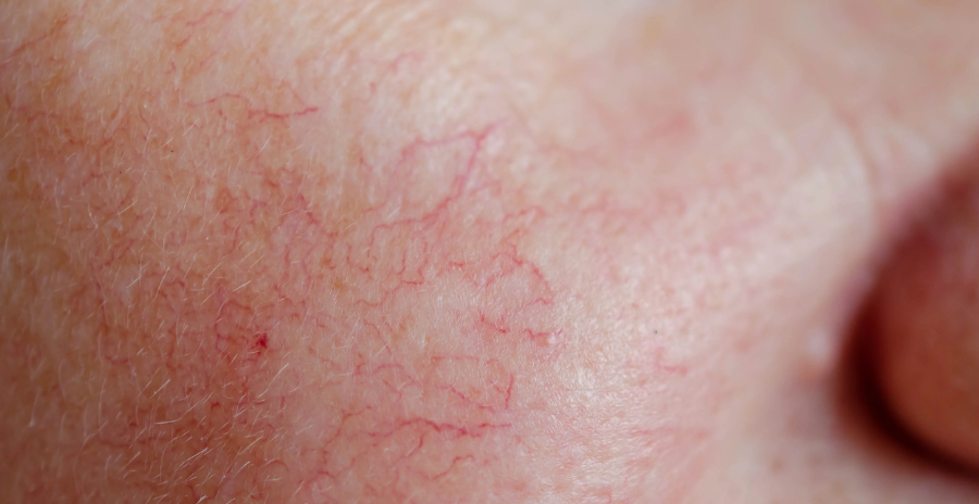 Can Laser Hair Removal Also Help With Spider Veins?