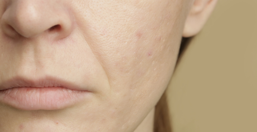 11 Treatments To Shrink Enlarged Pores On The Face