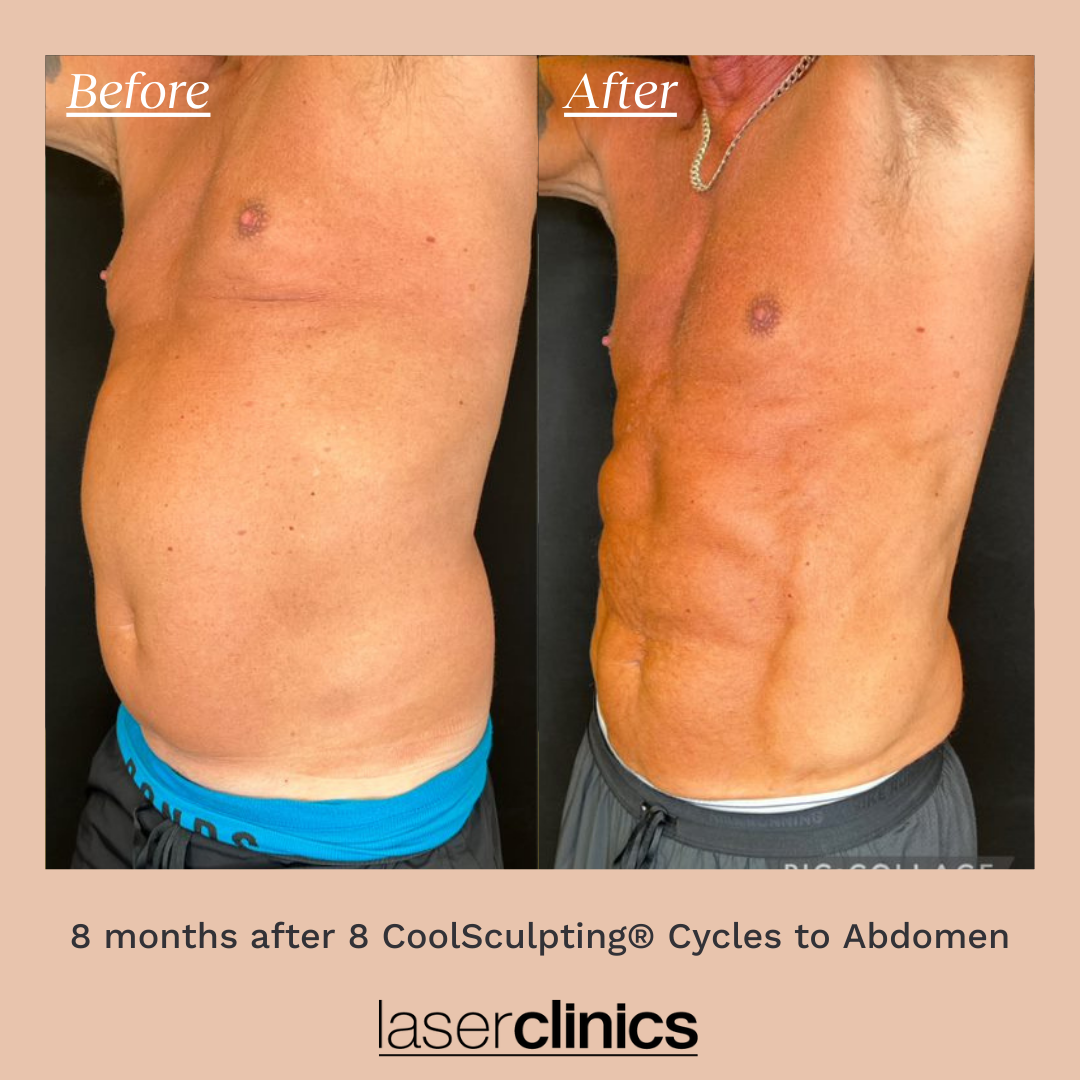 Coolsculpting® Fat Freezing Laser Clinics Australia