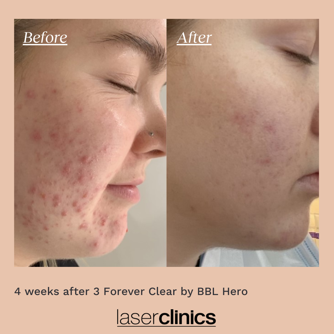 BBL Treatments | Laser Clinics Australia